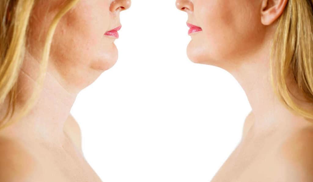 Double Chin treatment Selly Oak before and after results