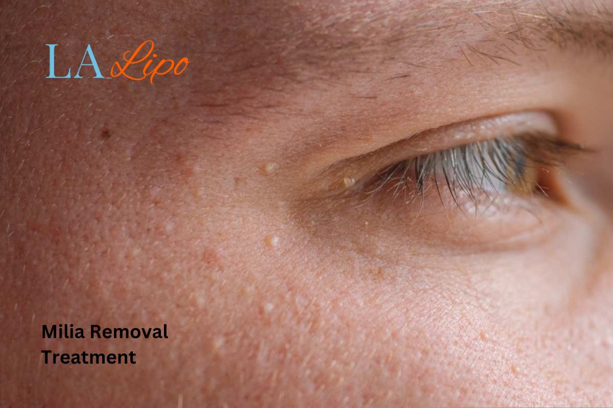 Cryopen Milia Removal: Is It the Easiest and Safest Option Selly Oak?