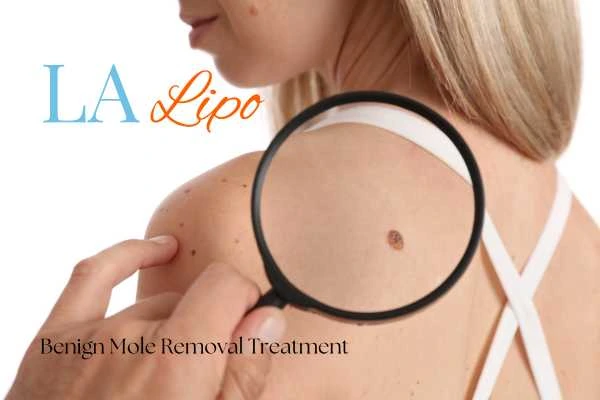 Woman having her inspection of blemish before mole removal Selly Oak
