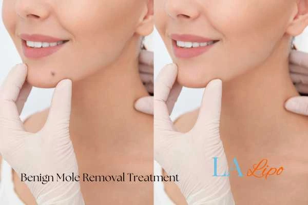 Before and after mole removal Selly Oak treatment