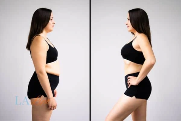 image of woman before and after results of LA-EMS Body Sculpting Selly Oak to help treat Diastasis recti