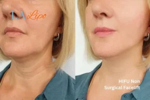 hi-fu for wrinkles Selly Oak before and after results