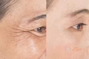 Before and after results of woman - HI-fu wrinkles reduction treatment Selly Oak