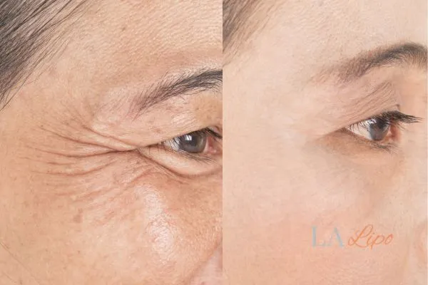 Before and after results of woman - HI-fu wrinkles reduction treatment Selly Oak