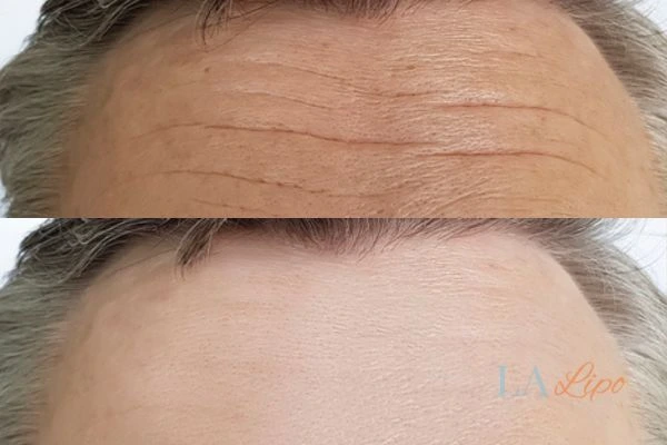 results of HIFU Selly Oak on mans forehead to help reduce lines and wrinkles