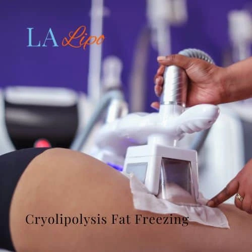 fat freezing - Cryolipolysis Selly Oak