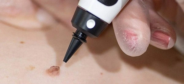 skin tag removal using cryopen Selly Oak