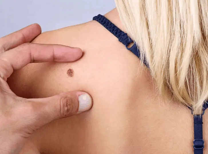 woman having mole removal Selly Oak consultation before treatment.
