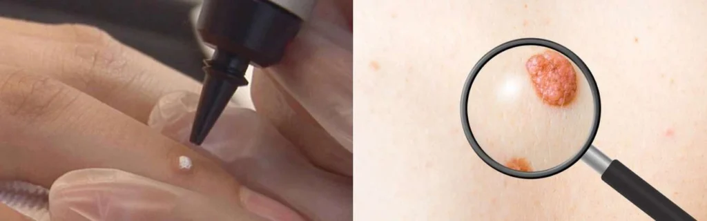 Person getting moles removed with cryopen Selly Oak