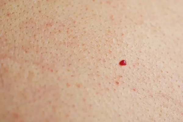 close up of a cherry angioma Selly Oak