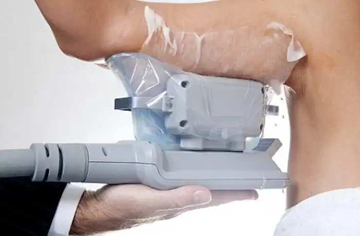 Picture of fat freezing Selly Oak on the upper arms.
