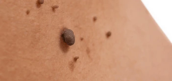 image of a skin tag Selly Oak