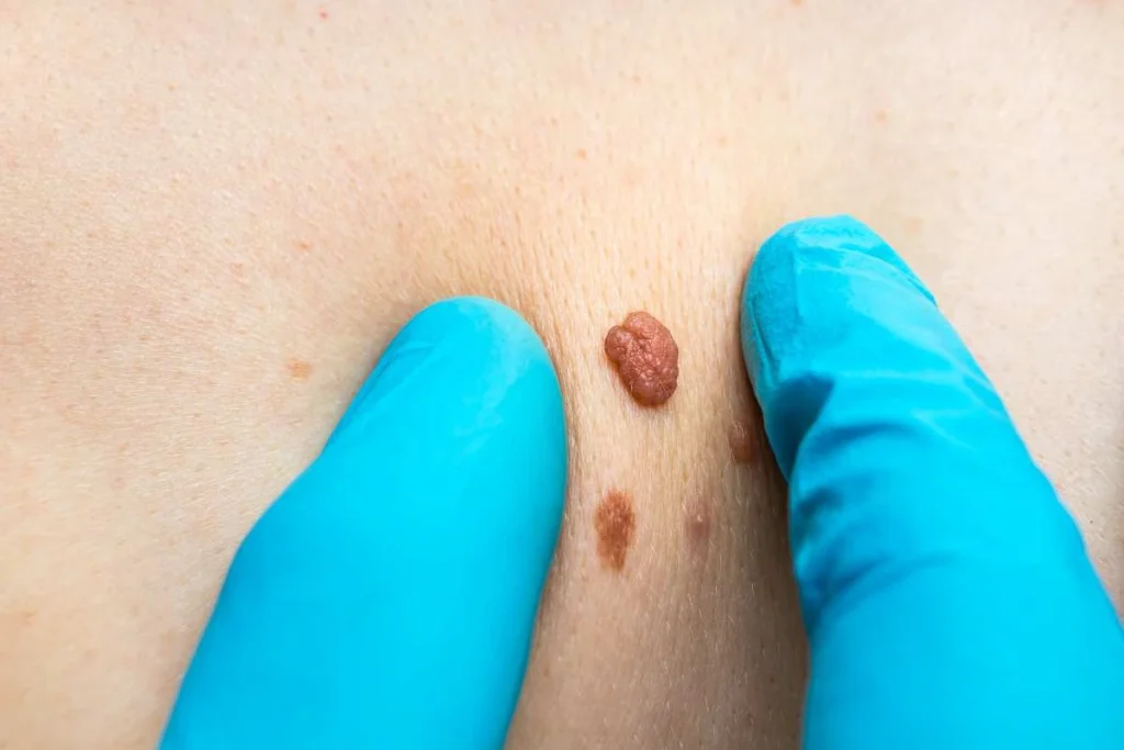 Consultant examining a skin tag Selly Oak