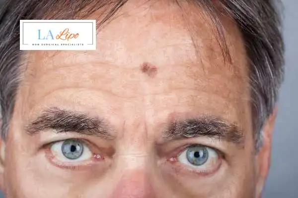 Solar Lentigo Removal Selly Oak image of man with mark on his forehead