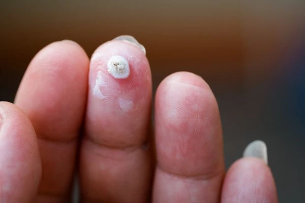 wart on person finger - cryotherapy to treat from LA LIPO Selly Oak