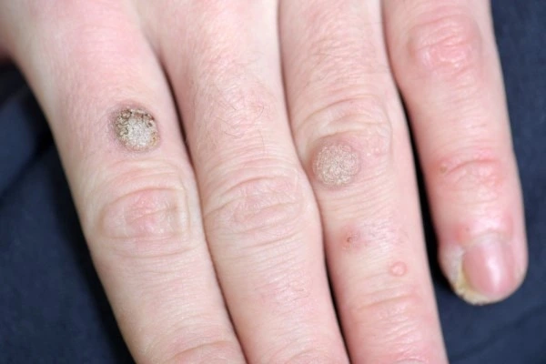 photo of warts on person hand - see wart removal Selly Oak from LA LIPO