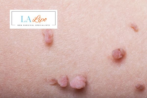 Does cryopen skin tag removal Selly Oak hurt? Find out now call our team today!