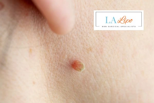 Book skin tag removal Selly Oak today speak to our team now!