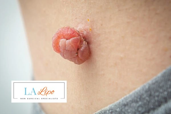 Interested in skin tag removal Selly Oak? Concerned about the pain? Find out more today!