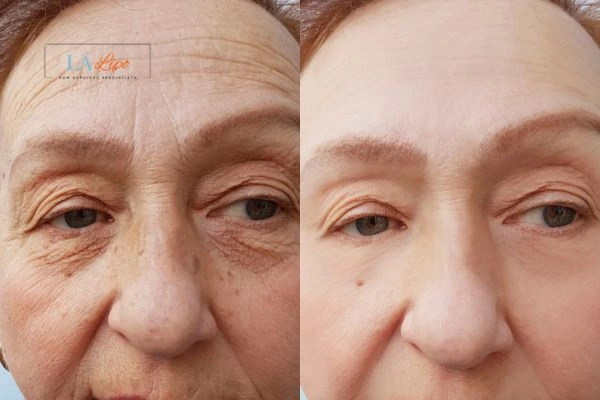 The powerful benefits of Morpheus8 Treatment Selly Oak - Call Our team today!