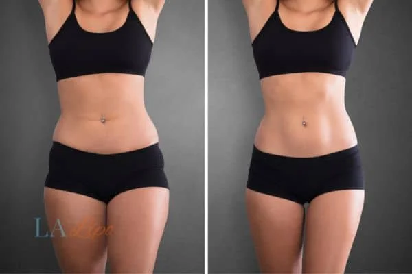 before and after results of non-surgical treatment to help a woman's body image and mental health Selly Oak