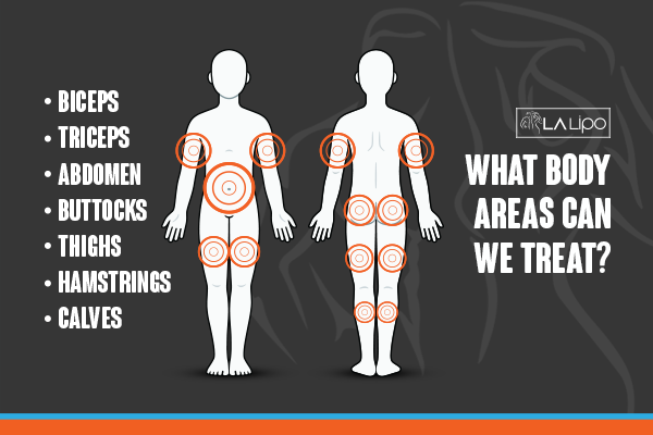 Diagram to show areas you can have LA-EMS Body Sculpting Treatment Selly Oak