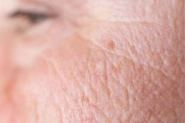 close up picture of a woman's face showing an age spot Selly Oak