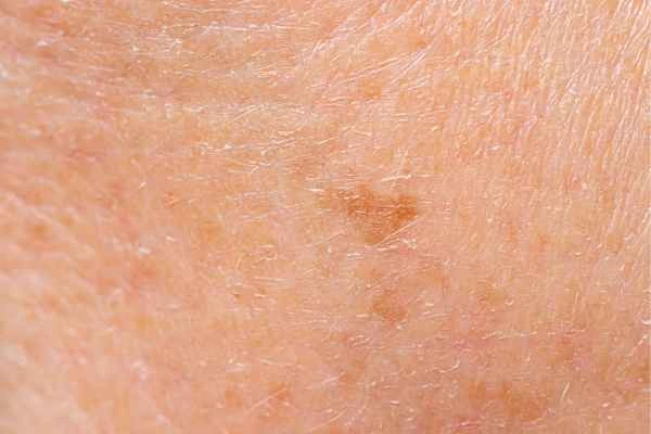 close up picture of age spots Selly Oak
