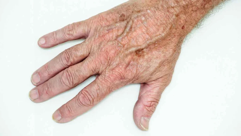Male hand showing age spot Selly Oak