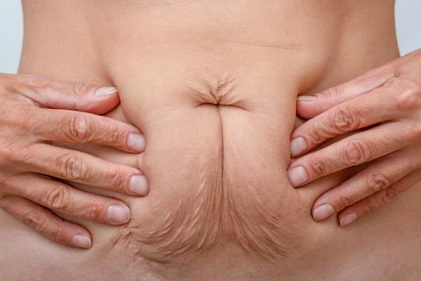 Image of a woman's stomach with loose skin - example of skin tightening Selly Oak options